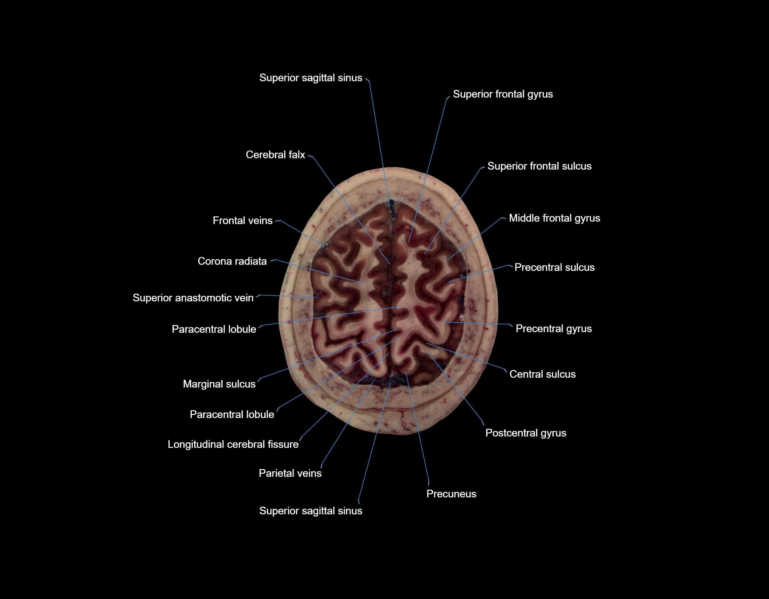 MRI Brain axial cross sectional radiology anatomy 3T image  -img-000067.webp